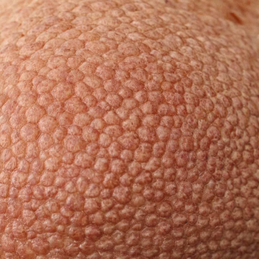 Wie sieht weißer Hautkrebs aus? Symptome früh erkennen und handeln