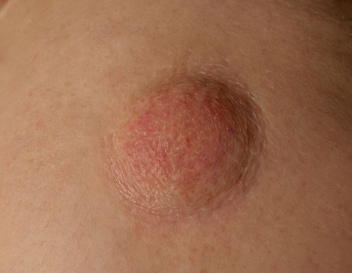 Weißliche, harte oder erhabene Hautareale   - Wie sieht weißer Hautkrebs aus? Symptome früh erkennen und handeln